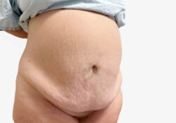 Tummy Tuck