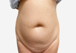 Tummy Tuck