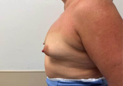 Breast Augmentation