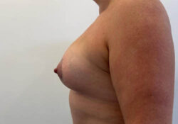 Breast Augmentation