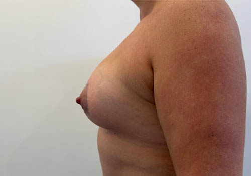 Breast Augmentation
