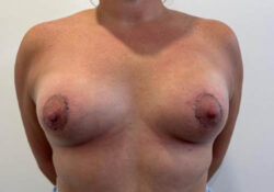 Breast Augmentation