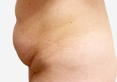 Tummy Tuck