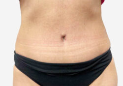 Tummy Tuck
