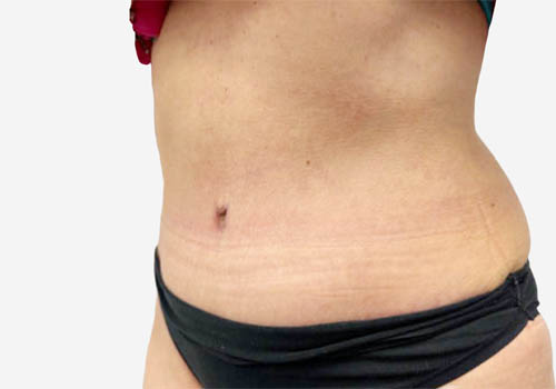Tummy Tuck