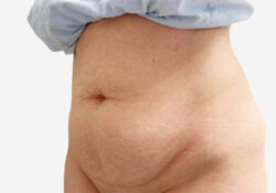 Tummy Tuck