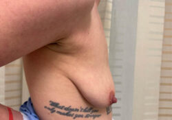 Breast Augmentation