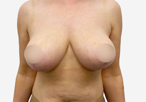 Breast Lift Case 6556 After Photo Breast Lift