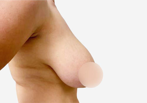 Breast Lift