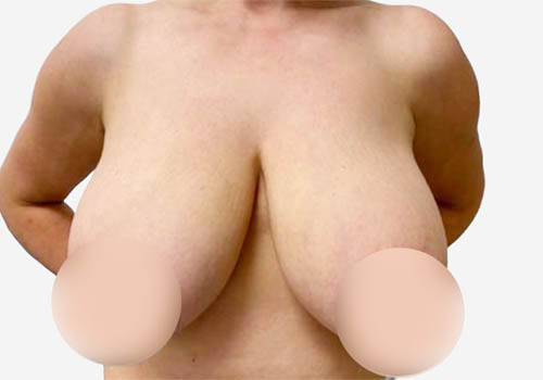 Breast Lift Case 6556 Before Photo Breast Lift