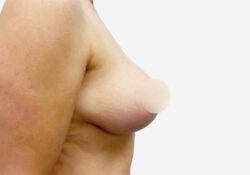 Breast Lift