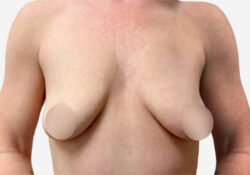 Breast Lift