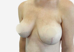 Breast Lift