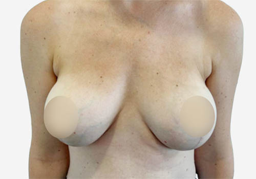Breast Lift Case 18163 After Photo Breast Lift
