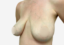 Breast Lift