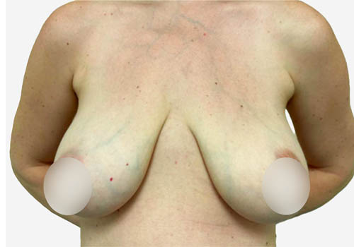 Breast Lift Case 18163 Before Photo Breast Lift