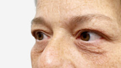 Eyelid Surgery