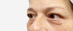 Eyelid Surgery