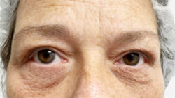 Eyelid Surgery