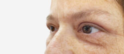 Eyelid Surgery