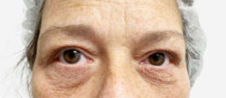 Eyelid Surgery
