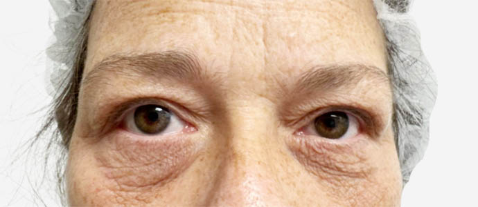 Eyelid Surgery
