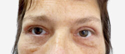 Eyelid Surgery