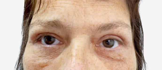 Eyelid Surgery