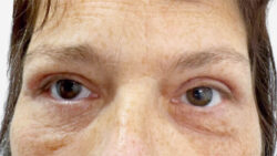 Eyelid Surgery