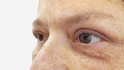 Eyelid Surgery
