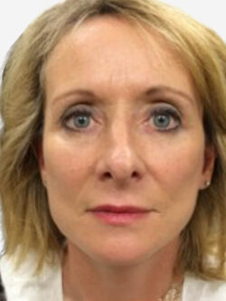 Face & Neck Lift