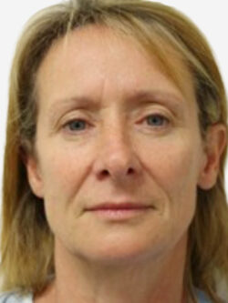 Face & Neck Lift