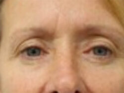 Face & Neck Lift