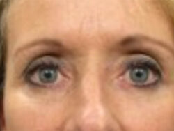 Face & Neck Lift