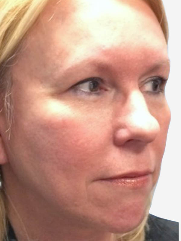 Facelift After Image in Toronto