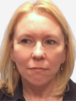 Face & Neck Lift