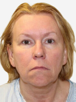 Face & Neck Lift