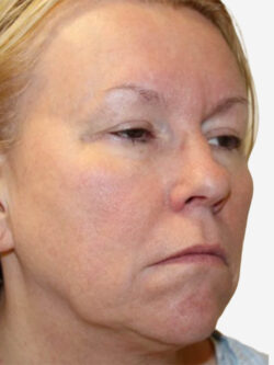 Face & Neck Lift