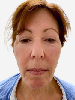 Face & Neck Lift