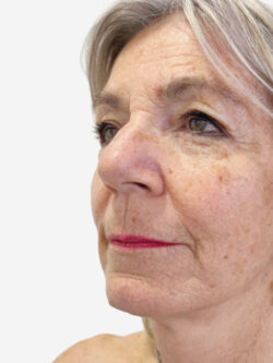 Face & Neck Lift