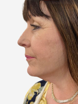 Face & Neck Lift
