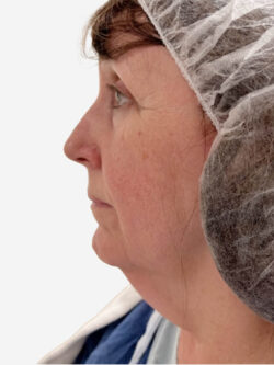 Face & Neck Lift