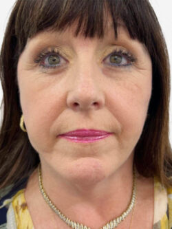 Face & Neck Lift