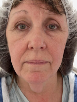 Face & Neck Lift