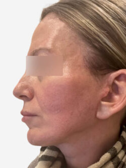 Face & Neck Lift