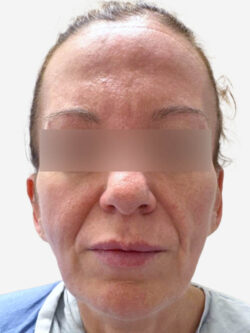 Face & Neck Lift