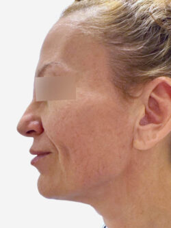 Face & Neck Lift