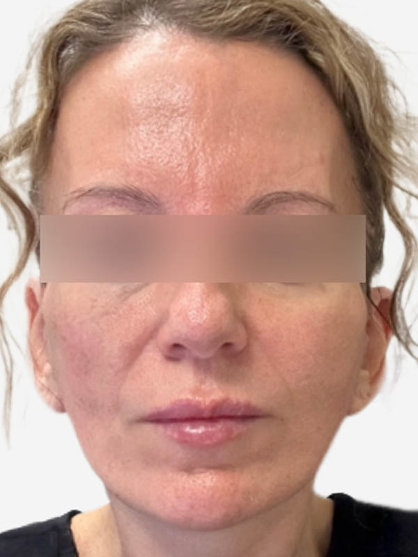 Face & Neck Lift