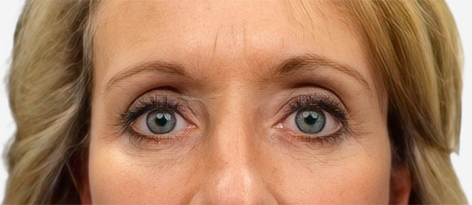 Eyelid Surgery