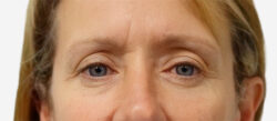 Eyelid Surgery